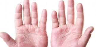 Come affrontare la Dermatite Atopica punto per punto: linee guida 2009 dermatite atopica 1