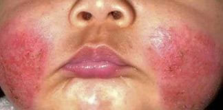 La dermatite atopica nei bambini dermatite atopica bambini