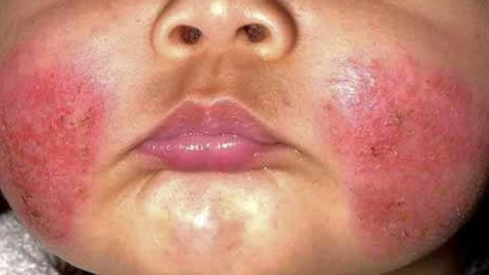 dermatite atopica bambini dermatite atopica bambini