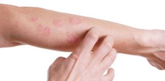 Dermatite allergica: 7 cose da sapere assolutamente dermatite allergica
