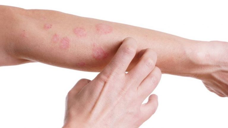 Dermatite allergica: 7 cose da sapere assolutamente