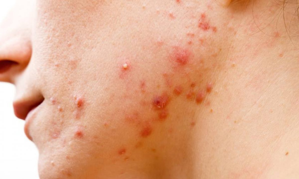 roaccutan prezzo italia