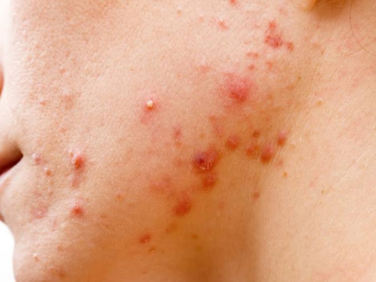 acne cheloidea cura