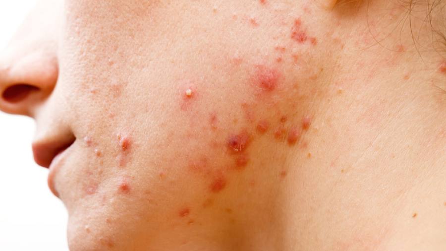 Isotretinoina Senza Prescrizione