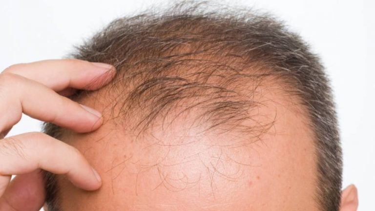 Il test genetico per l’alopecia androgenetica: chi deve farlo e come funziona