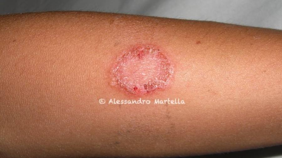 Micosi Cutanee Cura Prodotto Speciale Fillerina Viso
