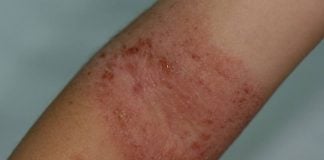 Dermatite atopica: la lettera di un bimbo a mamma e papà image_post_20140708234736