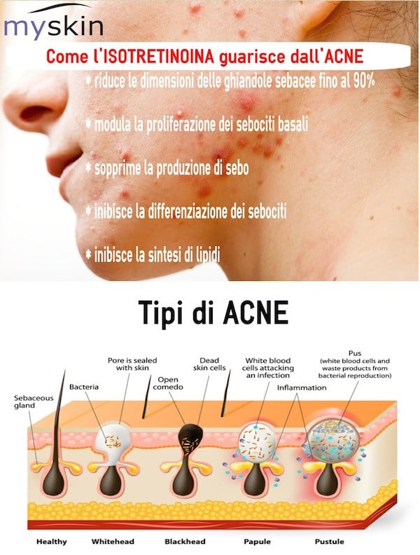 isotretinoina_infografica