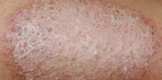 Macchie della pelle: cosa fare e non fare macchie pelle