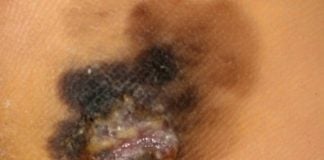 La diagnosi di melanoma e la nuova regola ABCDEFG melanoma