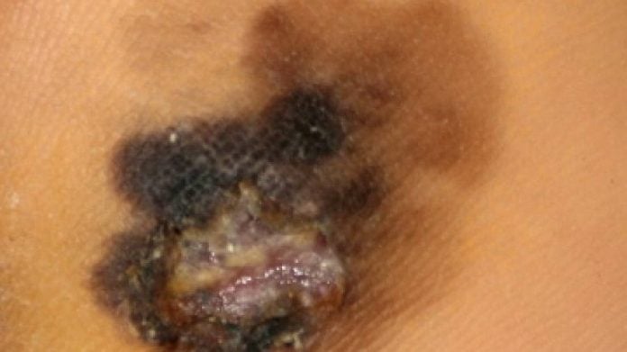 melanoma melanoma