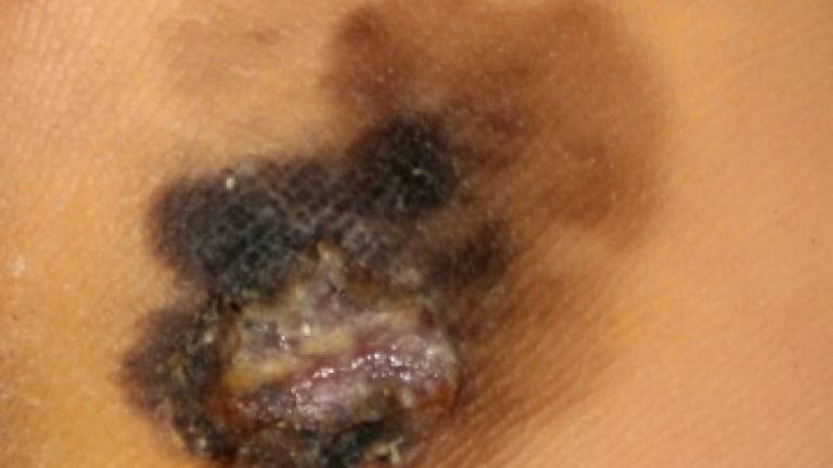 melanoma