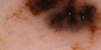 Il melanoma gioca a nascondino melanoma post