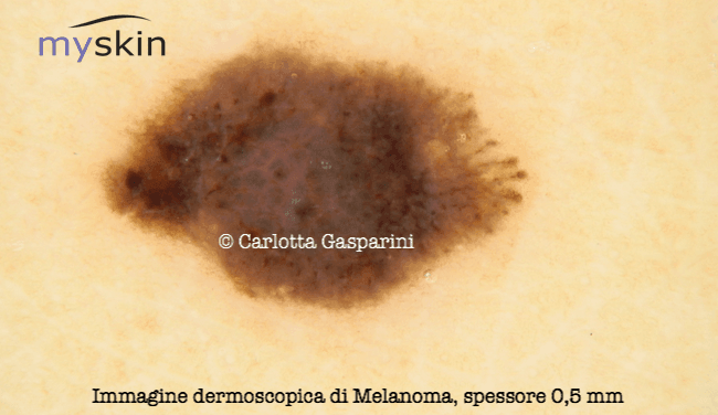 melanoma_immagine_dermoscopica