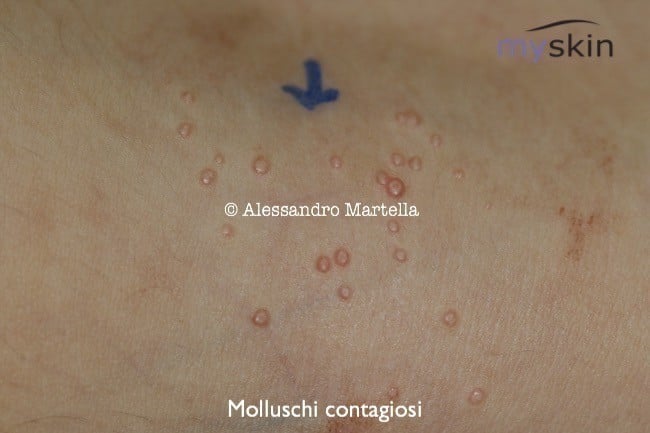 mollusco contagioso cura bambini