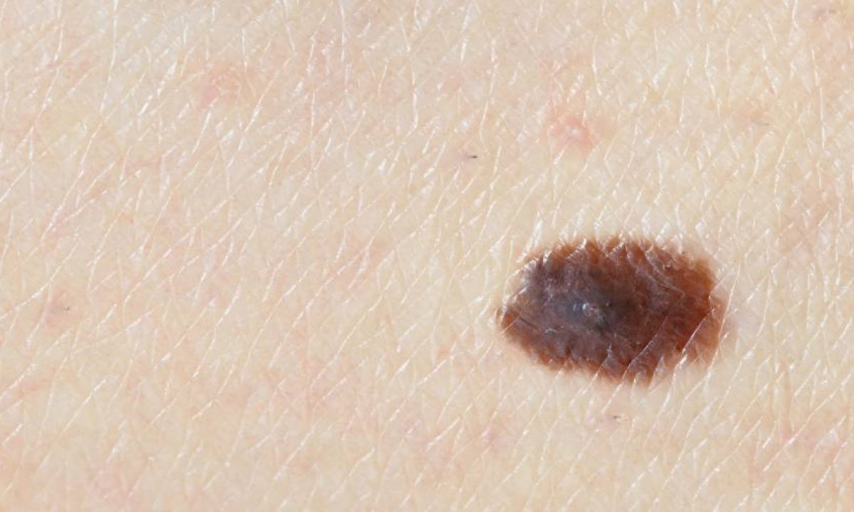 Cosa Significa Se Ho Un Neo Che Prude Myskin Dermatologi Online
