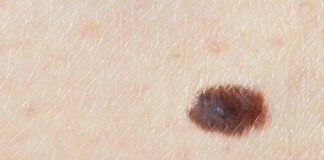 Su un nevo può comparire una dermatite? Il nevo di Meyerson neo che prude