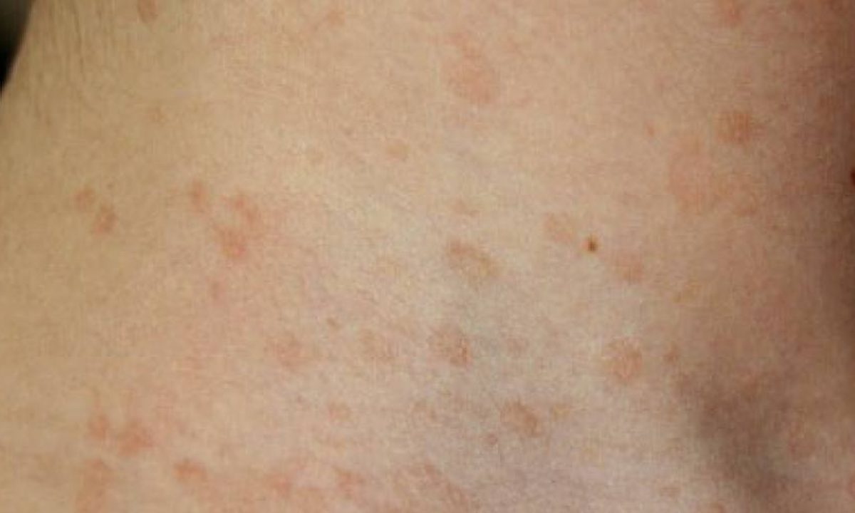 Pitiriasi Rosea Di Gibert