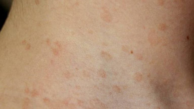 pitiriasi versicolor