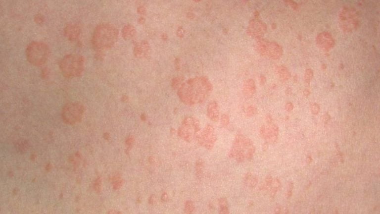 pitiriasi versicolor macchie