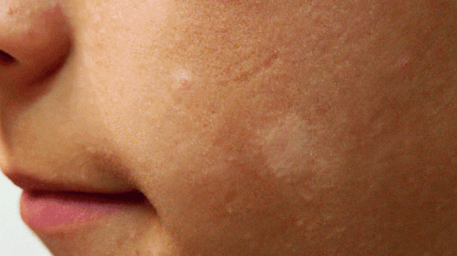 Macchie bianche al viso cosa sono e come trattarle Myskin