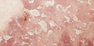 La fototerapia in dermatologia per il trattamento (anche a domicilio) di Psoriasi e Vitiligine psoriasi pelle