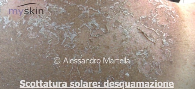 Scottatura solare - desquamazione