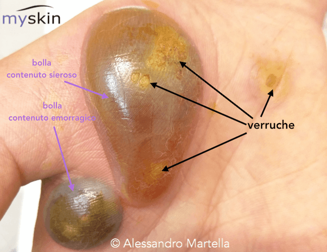 verruche_bolle