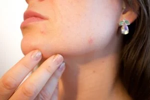 acne-depressione