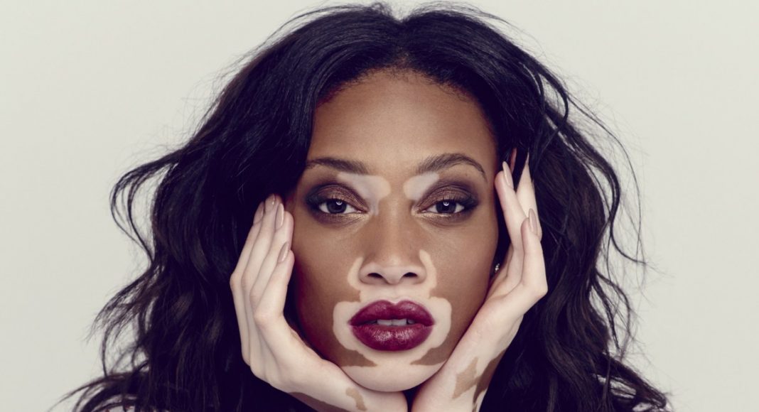 Esiste Un Trattamento Per La Vitiligine Myskin