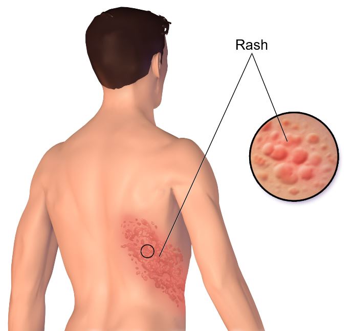 Herpes-Zoster-Rash-cutaneo