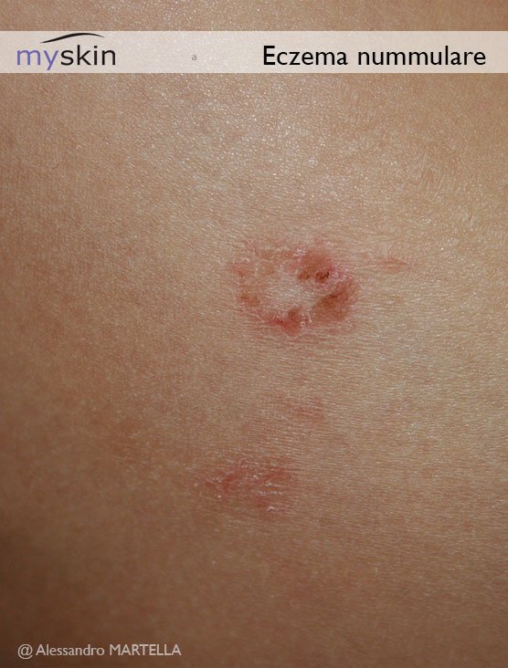 Eczematide-szerű purpura kezelésére pikkelysömör