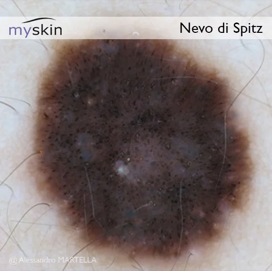 Nevo di Spitz - immagine dermatoscopica