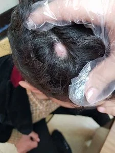 Cisti pilare: Visita dal dermatologo Cisti pilare: Visita dal dermatologo