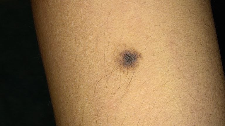 Come eliminare i peli dei nei