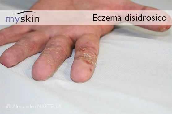 eczema disidrosico mani