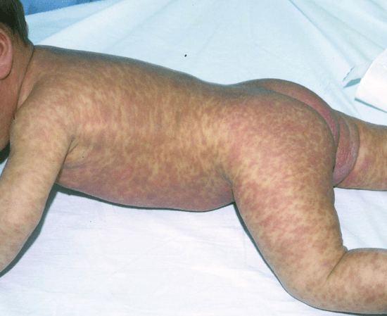 Mastocitosi cutanea nel neonato - Fonte merckmanuals.com