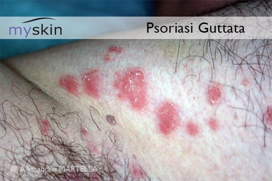 Immagine Psoriasi guttata