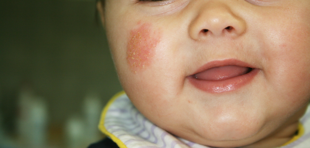 Impetigine sul volto di una bambina