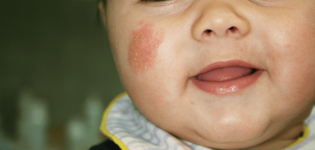 è uneruzione cutanea da streptoco contagiosa