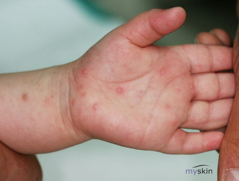 Malattia Bocca Mani Piedi : sintomi e trattamento