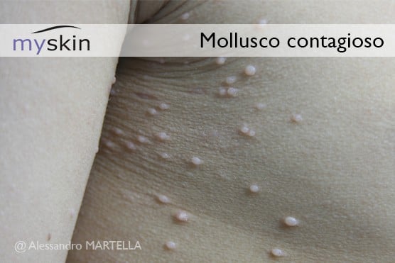 Mollusco-contagioso-bambino