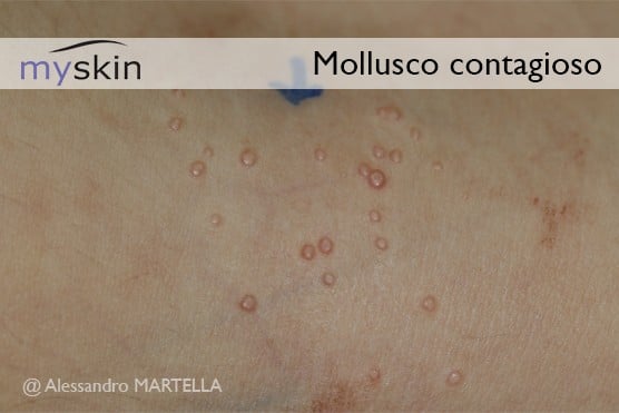 Mollusco-contagioso-immagine