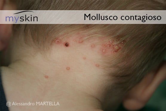 Mollusco-contagioso-nuca-bambino