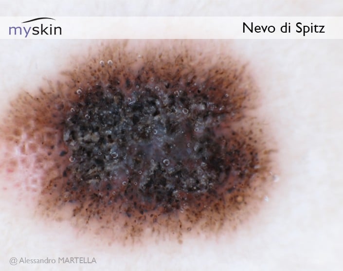 Nevo-di-Spitz-dermatoscopia