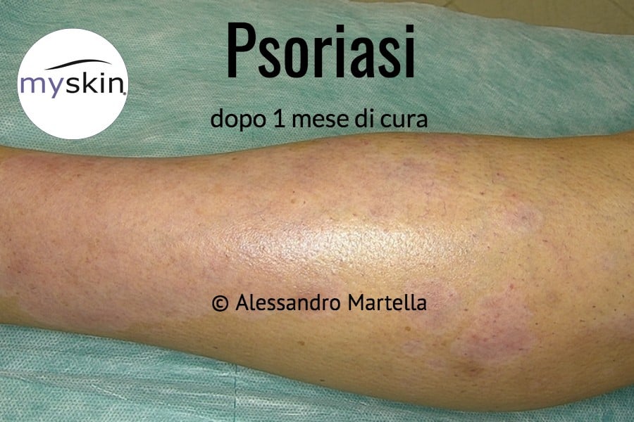 Foto di Psoriasi guarita