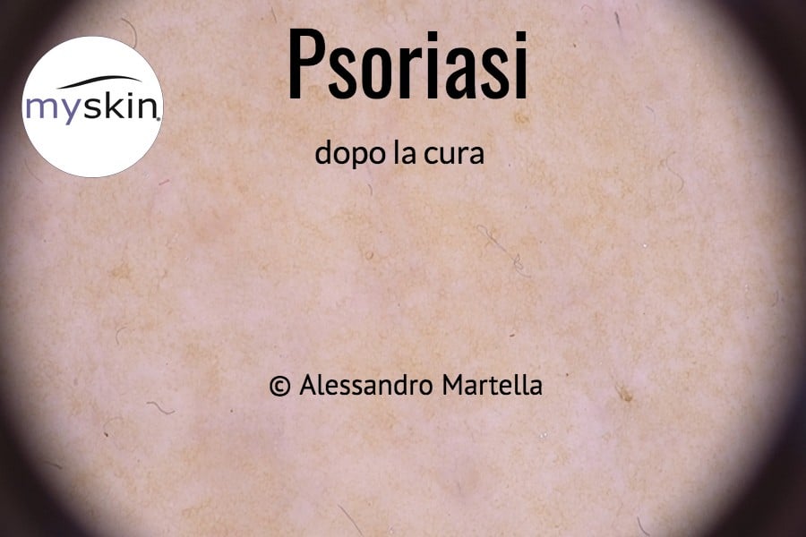 Psoriasi guarita dopo 1 mese di cura