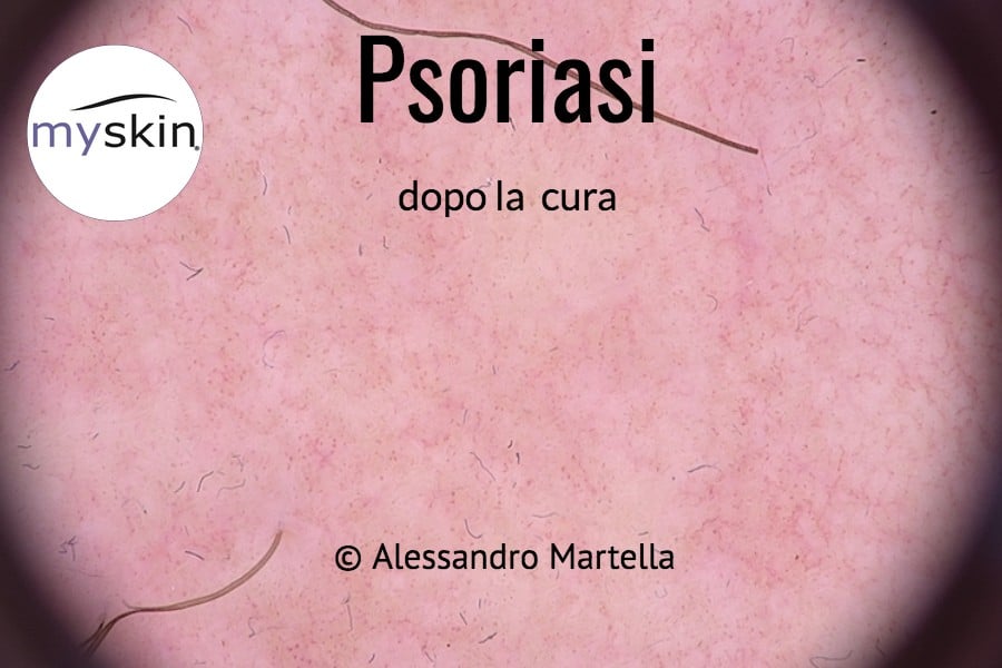 Psoriasi osservata in dermoscopia dopo 1 mese di cura