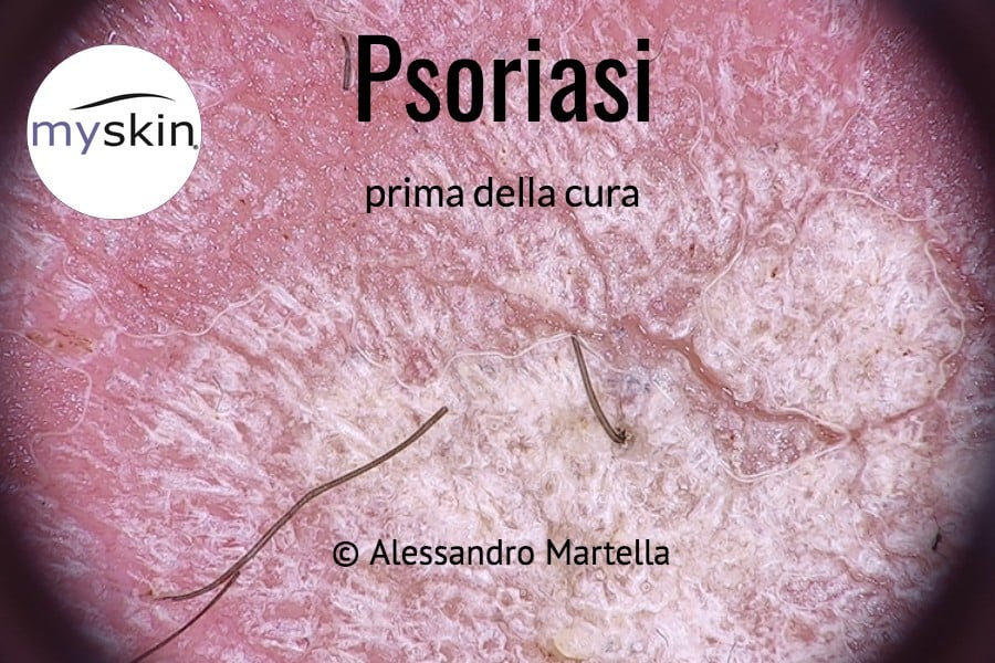 Psoriasi foto in dermatoscopia