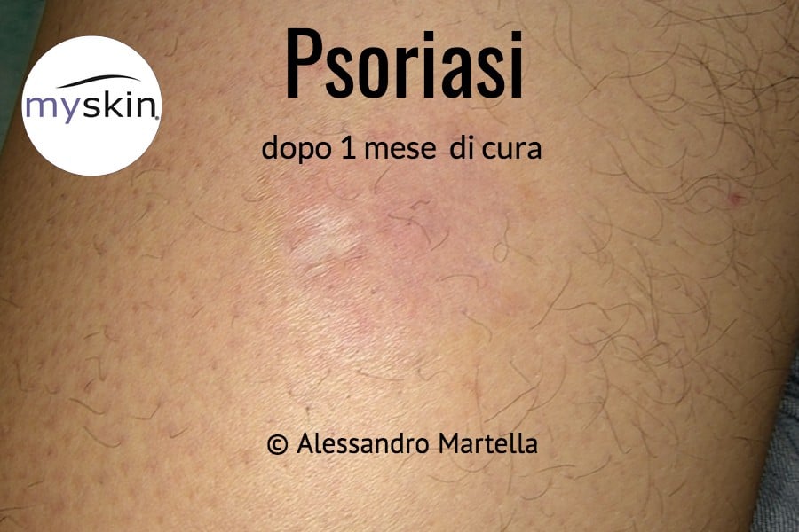 Psoriasi curata immagini